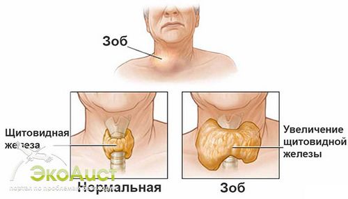 вилікувати дифузний зоб