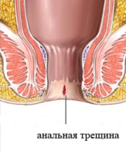 як лікувати геморой тріщини