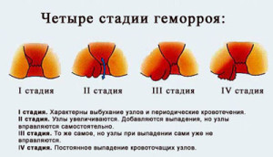 як лікувати геморой тріщини