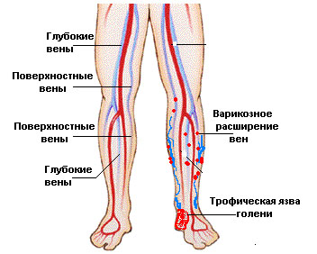 трофічна виразка на нозі