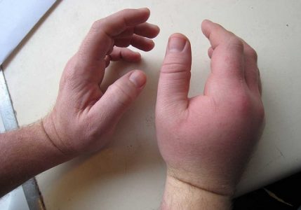 лікувати сильний удар пензля руки