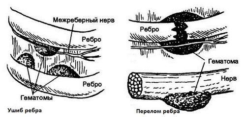 як лікувати забій ребра