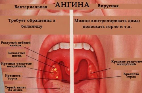 фарингіт тонзиліт лікування відрізнятися чому відмінність