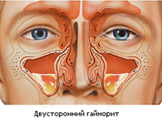 як лікувати верхньощелепної синусит