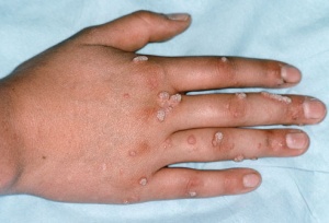 вірусна бородавка стопа заразна передається лікування палець руки