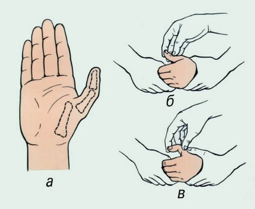 як лікувати розтягнення пальця руки