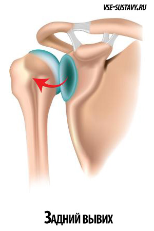 передній вивих плечового суглоба