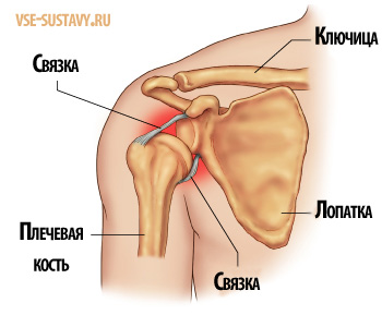 лікування вивиху плечового суглоба