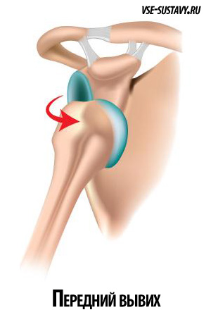 лікування вивиху плечового суглоба