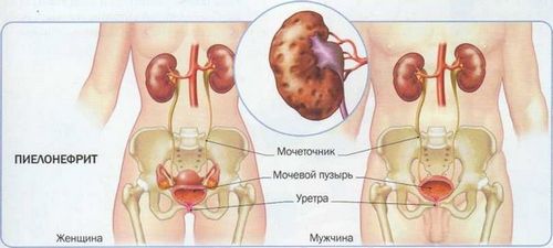 як лікувати запалення нирки