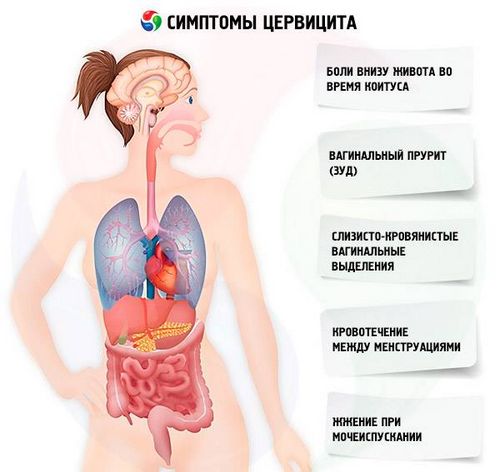 як лікувати цервіцит шийки матки