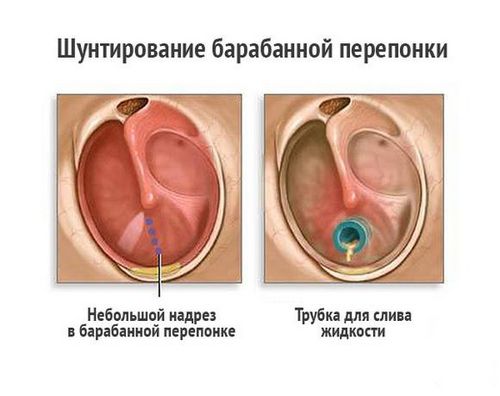 як лікувати вуха у грудничка