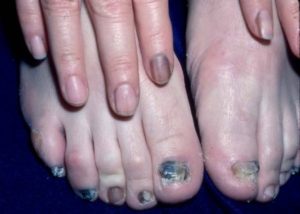 як лікувати нігті після грибка