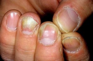 як лікувати нігті після грибка