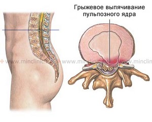 як лікувати хропіння у підлітка