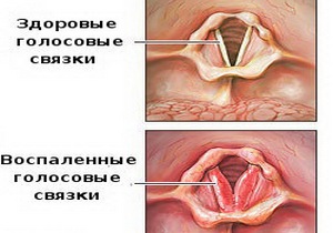 хронічний ларингіт симптом лікування дорослий гиперпластический як лікувати гипертрофический народні засоби