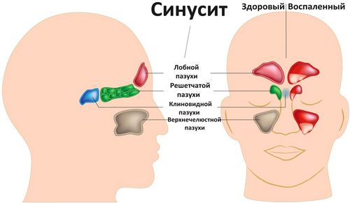 хронічний нежить синусит