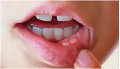 як лікувати стоматит під губою