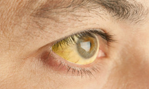 як вилікувати жировик на білку ока