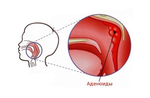 як лікувати аденоїди у грудничка