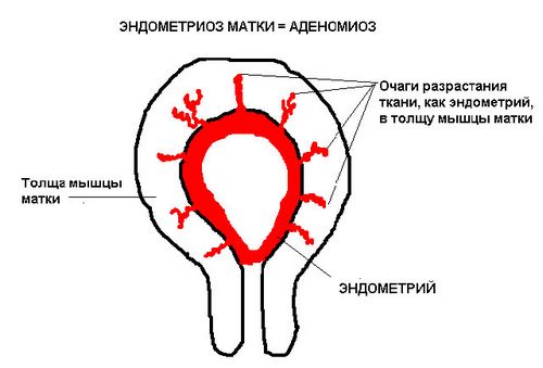 як лікувати вогнищевий ендометріоз