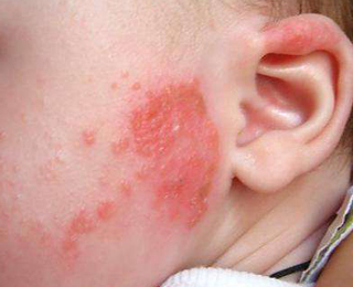 алергія особа набряк пляма