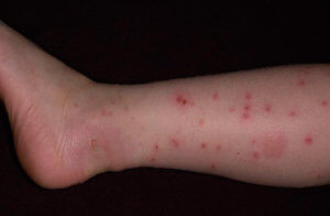 алергія на укуси клопів і бліх фото і симптоми