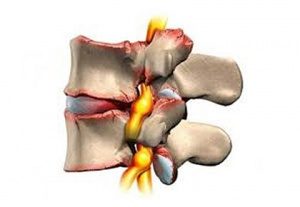 як лікувати артроз хребта
