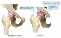 як лікувати суглоби тазостегнові