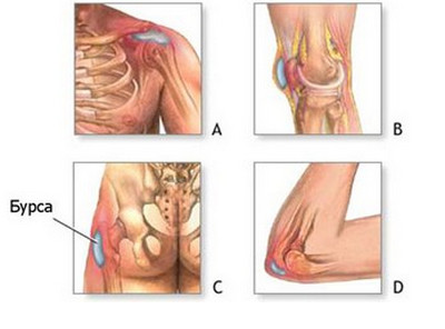 бурсит симптоми колінного суглоба ліктьового тазостегнового