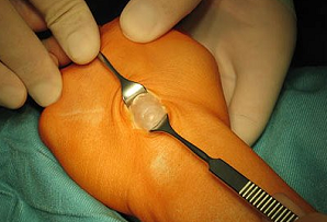 гігрома пальця лікування без операції