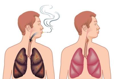 як лікувати емфізему легенів