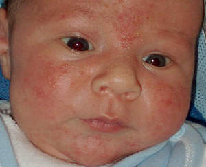 стрептодермія дитина фото стрептодермии дорослий лікування