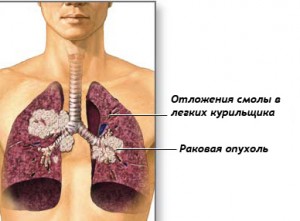 як лікувати рак легенів народними засобами
