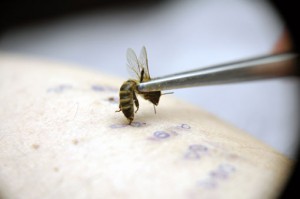 бджоли лікування варикоз