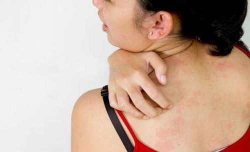 розацеаподобний дерматит причини симптоми лікування