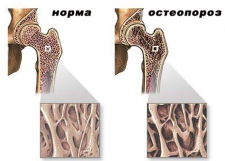 остеопороз тазостегнового суглоба симптоми лікування