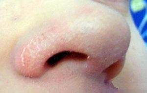 як лікувати себорею навколо носа