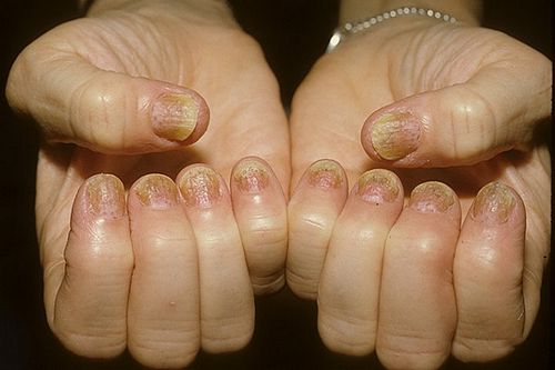 як лікувати псоріаз нігтів на руках