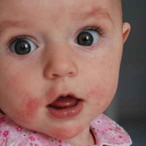 як лікувати дерматит на попі у дитини