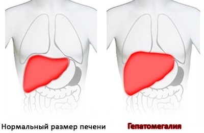 як лікувати печінку якщо вона збільшена