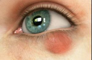 халязион верхньої повіки нижнього причини симптоми лікування операція очей мазі краплі