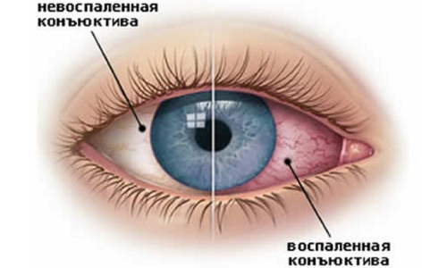 як лікувати хламідіоз очей