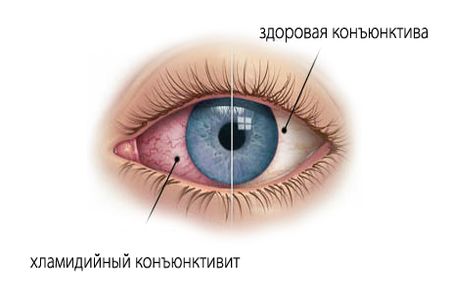 як вилікувати хламідіоз очей