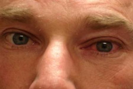 як вилікувати хламідіоз очей