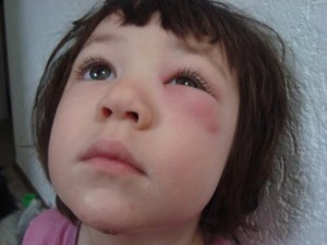 ангіоневротичнийнабряк при вагітності ангіоневротичнийнабряк при вагітності