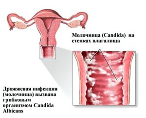вагітна, вагітної, вагітним, вагітних, будинки, домашніх, жінок, жінка, запахами, знаючи, як, лікувала, лікувати, методами, можна, молочниця, молочницю, народні, народними, першому, роті, кошти, триместрі, умовах, ніж, вагітність умовах