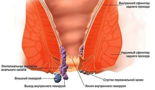 геморой у вагітних що робити геморой у вагітних що робити
