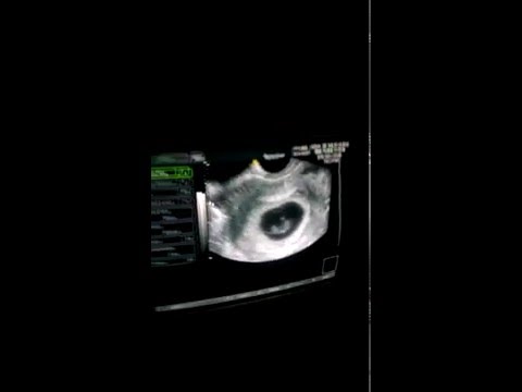 щоденник вагітності 8 тиждень щоденник вагітності 8 тиждень