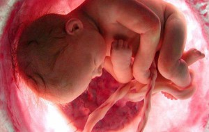 чи можна завагітніти при міомі матки, чи можна народити з міомою матки, вагітність і міома матки малих розмірів, міома матки під час вагітності, міома матки і вагітність відгуки, міома на задній стінці матки і вагітність, можна завагітніти при міомі матки, пологи з міомою матки, як впливає міома матки на вагітність, лікування міоми матки при вагітності, чи можна робити еко при міомі матки, еко при міомі матки, чи можна вагітніти при міомі матки, міома матки після пологів, чи можна завагітніти після видалення міоми матки, чи проходить міома матки після пологів, чи можливо завагітніти при міомі матки, як завагітніти з міомою матки, вагітність після операції міоми матки, чим небезпечна міома матки при вагітності, вагітність при міомі матки великих розмірів, роблять чи еко при міомі матки, переривання вагітності при міомі матки, міома матки при вагітності фото, пологи з міомою матки відгуки, міома матки симптоми і ознаки при вагітності, заважає міома матки завагітніти міома матки симптоми і ознаки при вагітності